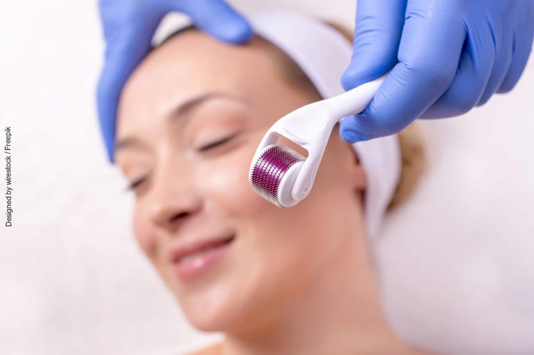 Microneedling: revolucionando o tratamento de cicatrizes e rugas